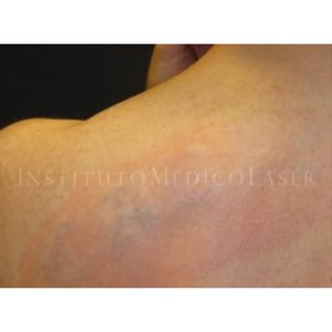 Resultados antes y después del láser para eliminar tatuajes
