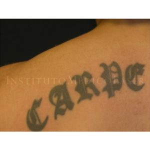 Resultados antes y después del láser para eliminar tatuajes