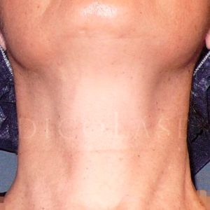Resultados antes y después del Minilifting del cuello