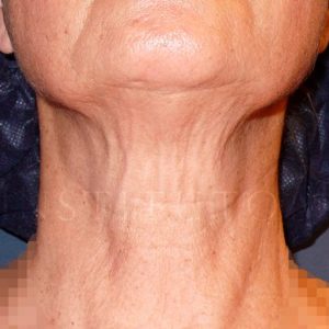Resultados antes y después del Minilifting del cuello