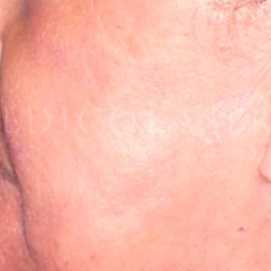 Resurfacing en mejillas, antes y después