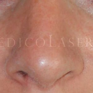 Rinoplastia parcial antes y después