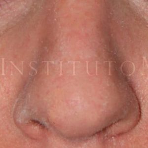 Rinoplastia parcial antes y después