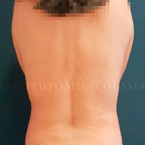 Resultado antes y después de los rollitos en la espalda