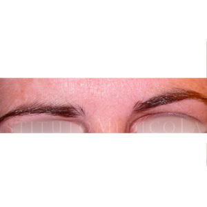 Antes y después un tratamiento de Simetrización de cejas