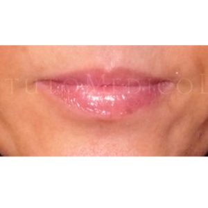 Pliegues genianos, antes y después