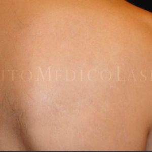 Antes y después de borrar tatuaje con láser