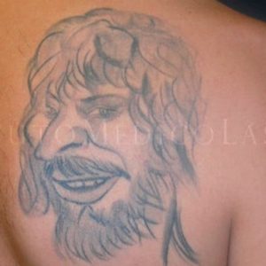 Antes y después de borrar tatuaje con láser