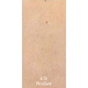 Eliminación de tatuaje recalcitrante, antes y después