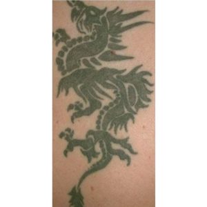 Eliminación de tatuaje recalcitrante, antes y después