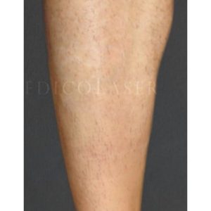 Resultados pre y post láser para tatuajes