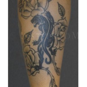 Resultados pre y post láser para tatuajes