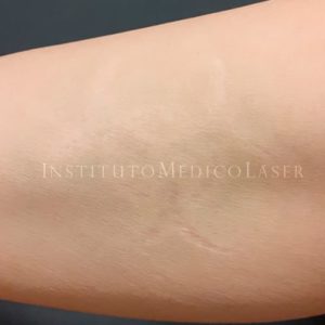 Tatuajes con láser Picosure, antes y después