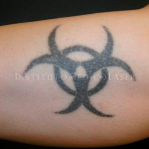Tatuajes con láser Picosure, antes y después