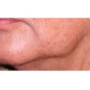 Antes y después del tensado de la rama mandibular