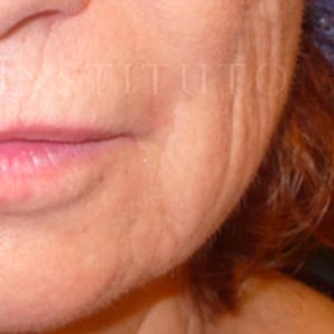 Tratamiento de arrugas en las mejillas, antes y después