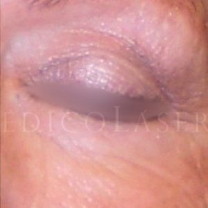 Tratamiento para el contorno de ojos, antes y después