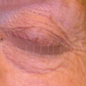 Tratamiento para el contorno de ojos, antes y después