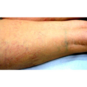 Quitar varices con láser antes y después