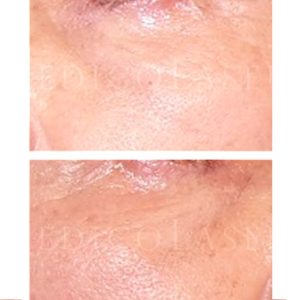 Antes y después del tratamiento de ojeras marrones con láser