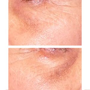 Antes y después del tratamiento de ojeras marrones con láser