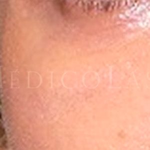 Párpado inferior: resultados del tratamiento