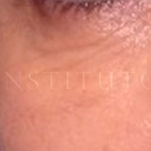 Párpado inferior: resultados del tratamiento
