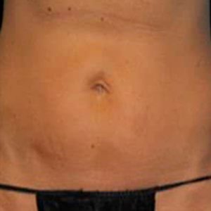 Antes y después de Vanquish ME para reducir la grasa localizada en el abdomen.