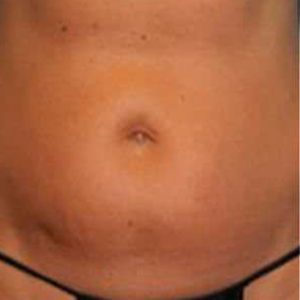 Antes y después de Vanquish ME para reducir la grasa localizada en el abdomen.