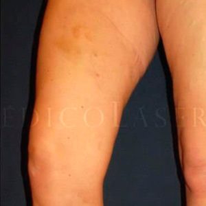 Laser endovenoso para varices graves, antes y después