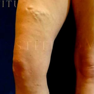 Laser endovenoso para varices graves, antes y después