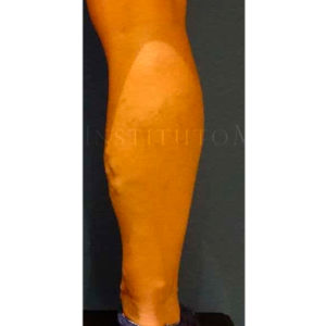 Eliminar varices en las piernas con endoláser, antes y después
