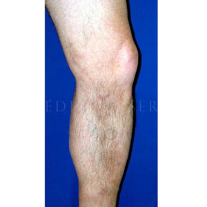 Varices graves antes y después
