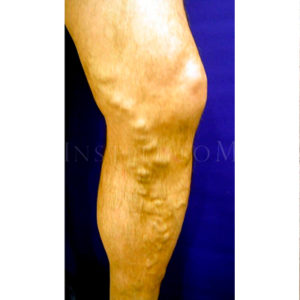 Varices graves antes y después