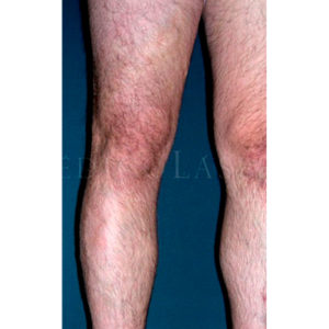Varices sin cirugía antes y después