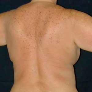Vaser en espalda - Fotos del antes y después