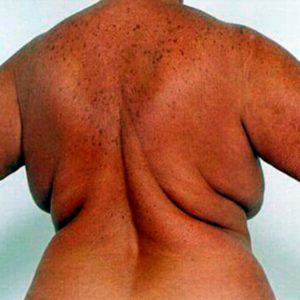 Vaser en espalda - Fotos del antes y después