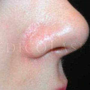 Antes y después de eliminar una telangiectasia facial