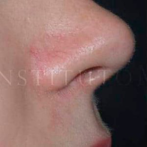 Antes y después de eliminar una telangiectasia facial