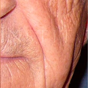 Volumen en mejillas, antes y después