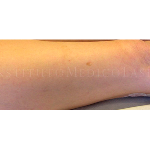 Foto antes y después del tratamiento de varices