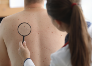 ¿Cómo se puede tratar el cáncer de piel?