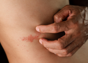 ¿Cómo tratar el herpes zoster?