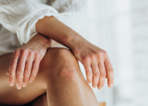 Psoriasis