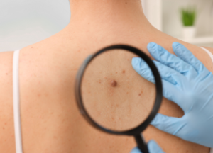 Tratamiento cáncer de piel