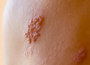 Tratamiento herpes zoster
