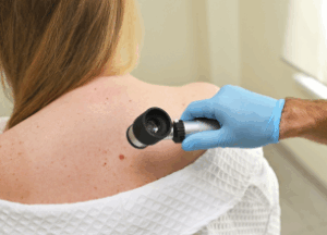 Tratamientos para el melanoma