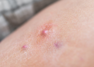 Hidradenitis supurativa