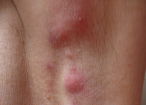 Tratamientos para la hidradenitis supurativa
