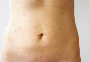 Tratamiento liquen plano